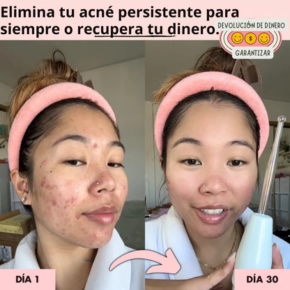 Solvia™ – Varita de Alta Frecuencia Facial y Capilar