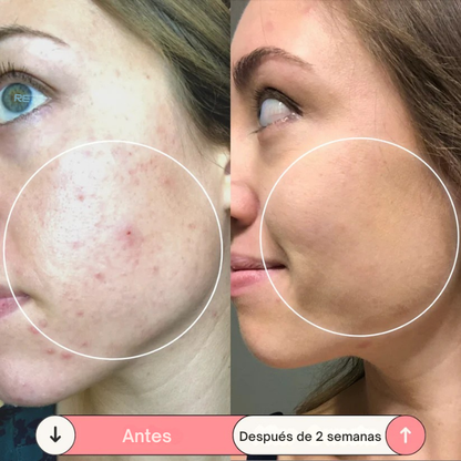 Solvia™ – Varita de Alta Frecuencia Facial y Capilar