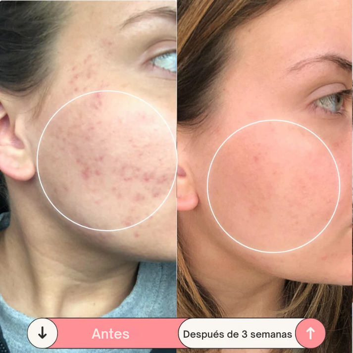 Solvia™ – Varita de Alta Frecuencia Facial y Capilar