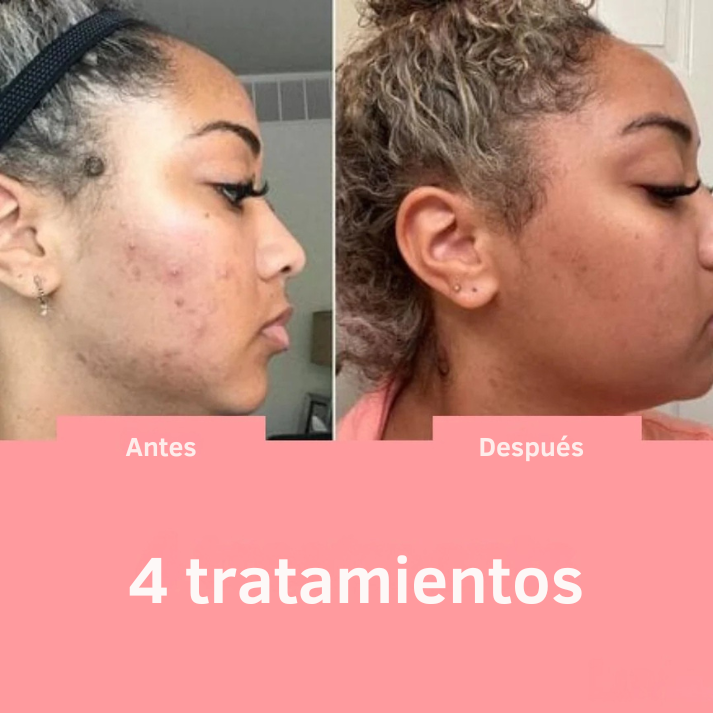 Solvia™ – Varita de Alta Frecuencia Facial y Capilar