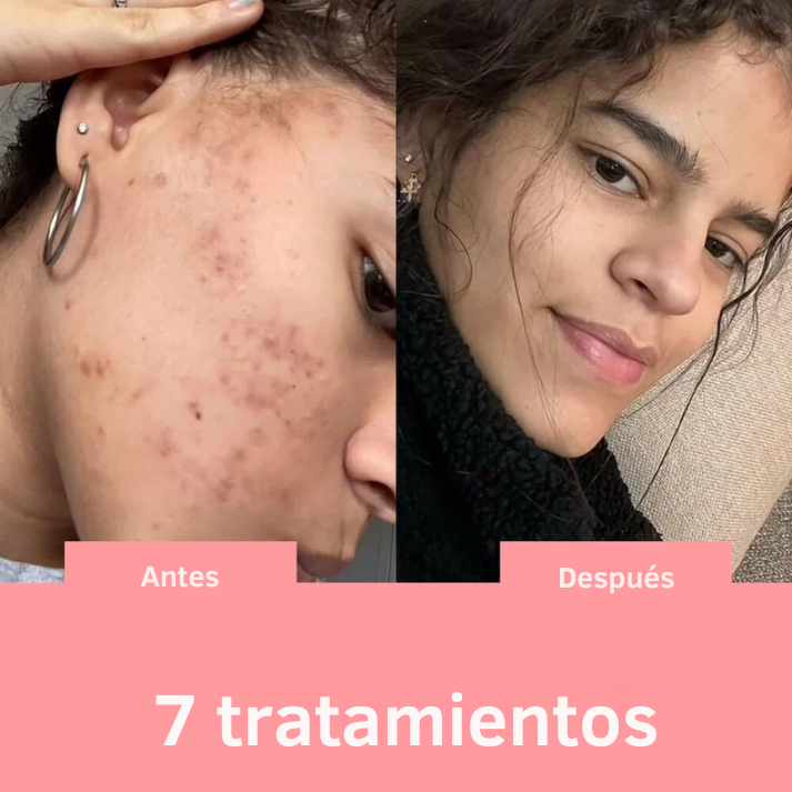 Solvia™ – Varita de Alta Frecuencia Facial y Capilar