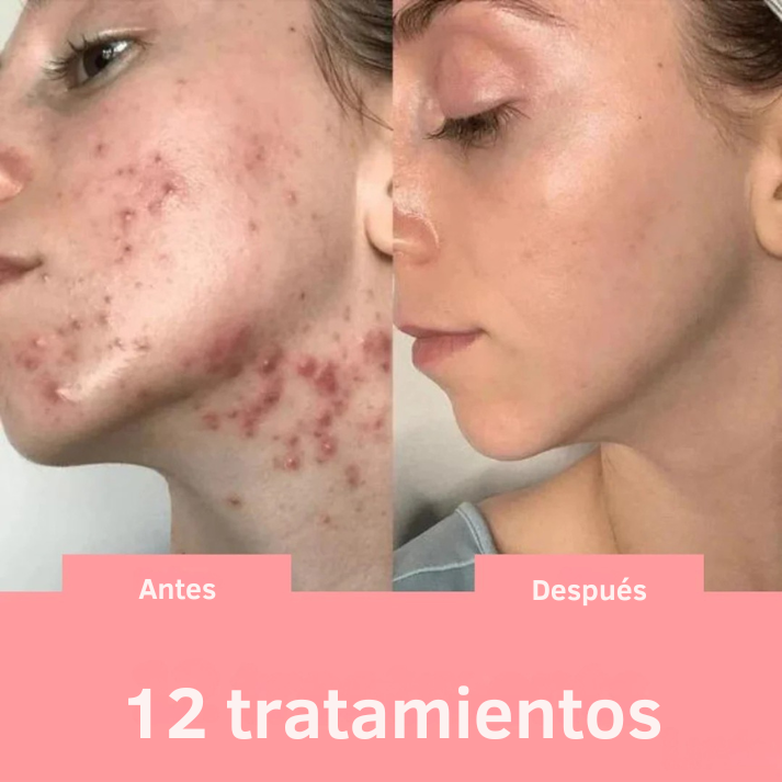 Solvia™ – Varita de Alta Frecuencia Facial y Capilar
