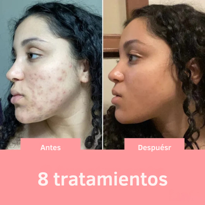 Solvia™ – Varita de Alta Frecuencia Facial y Capilar